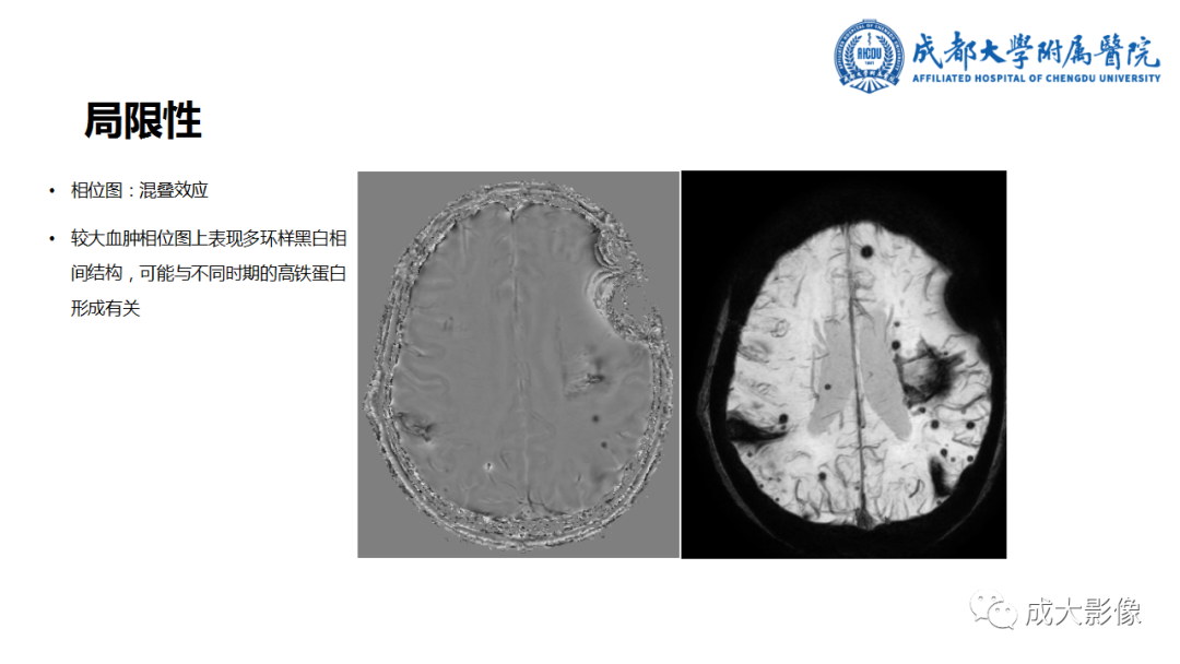 【PPT】SWI在中枢神经系统疾病中的应用-41