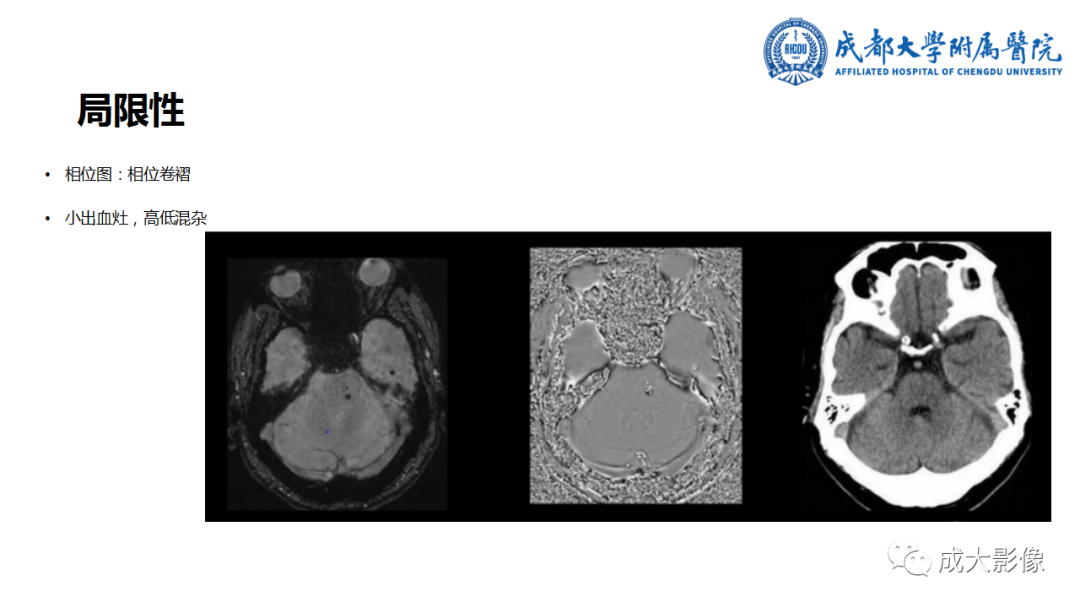 【PPT】SWI在中枢神经系统疾病中的应用-42
