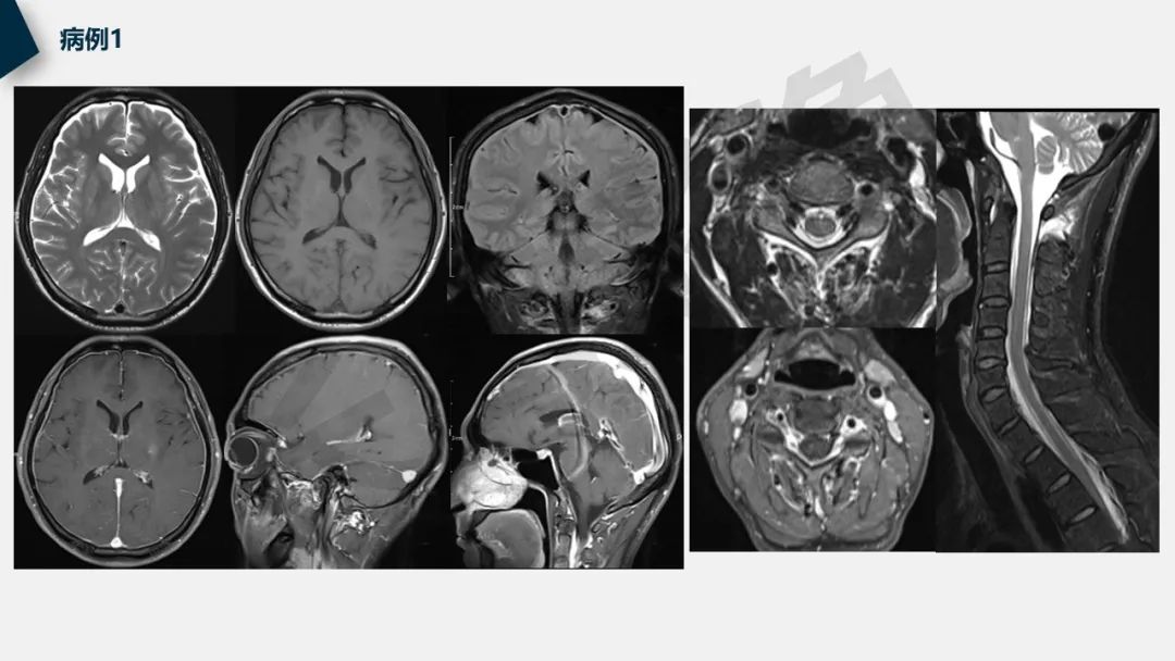 【PPT】低颅压综合征-2