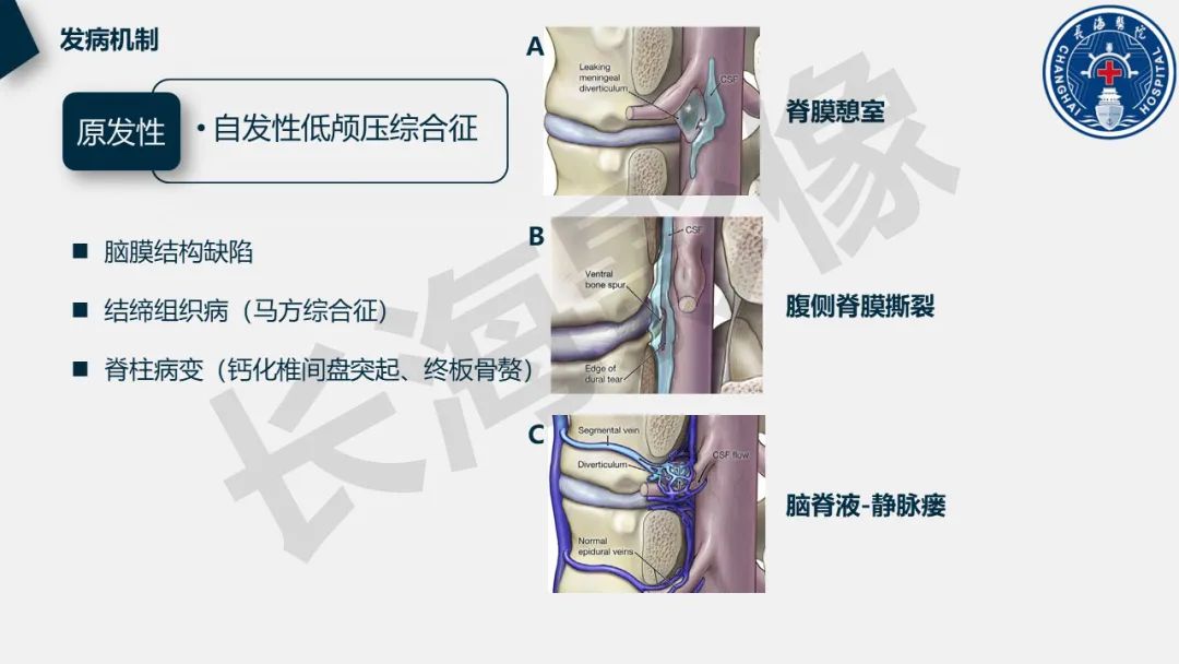 【PPT】低颅压综合征-11