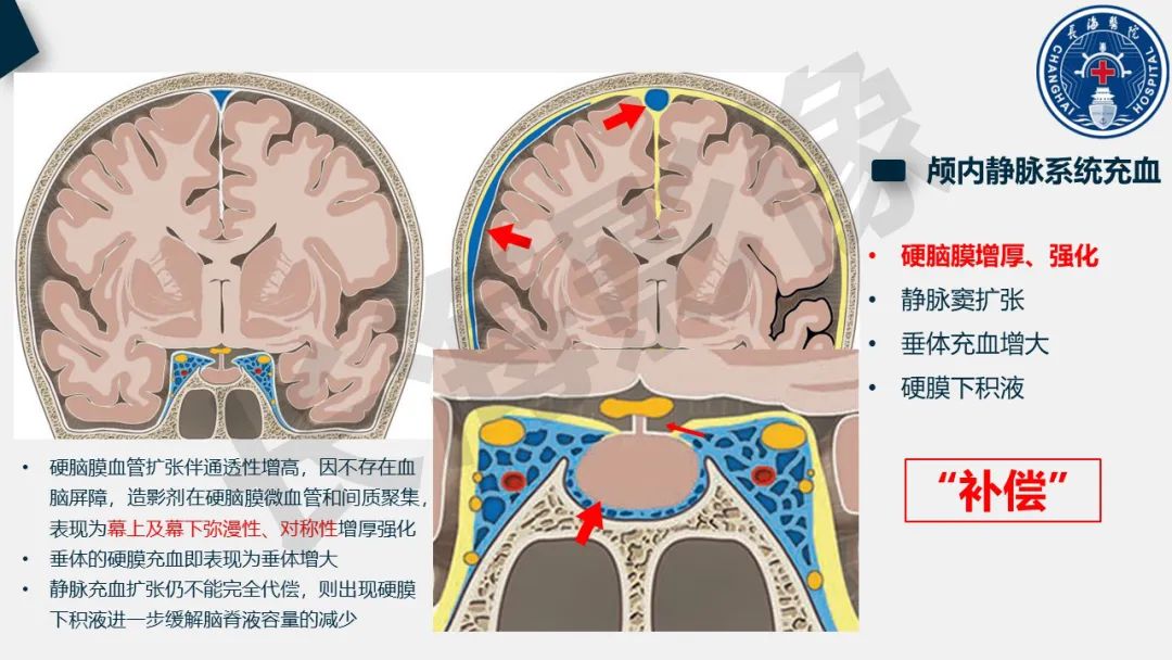 【PPT】低颅压综合征-17