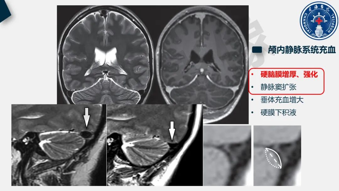 【PPT】低颅压综合征-18