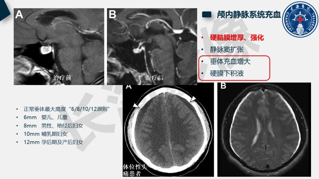 【PPT】低颅压综合征-19