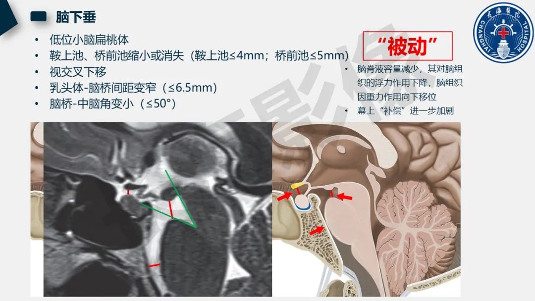 【PPT】低颅压综合征-20