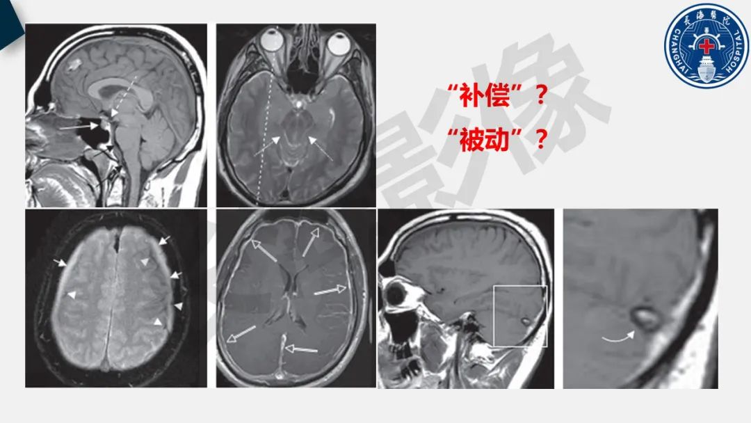 【PPT】低颅压综合征-21