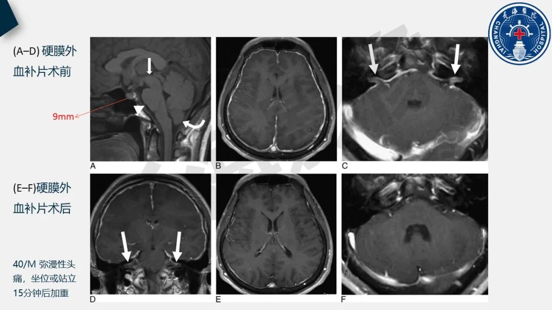 【PPT】低颅压综合征-22