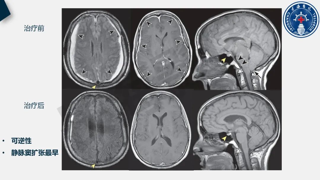 【PPT】低颅压综合征-23