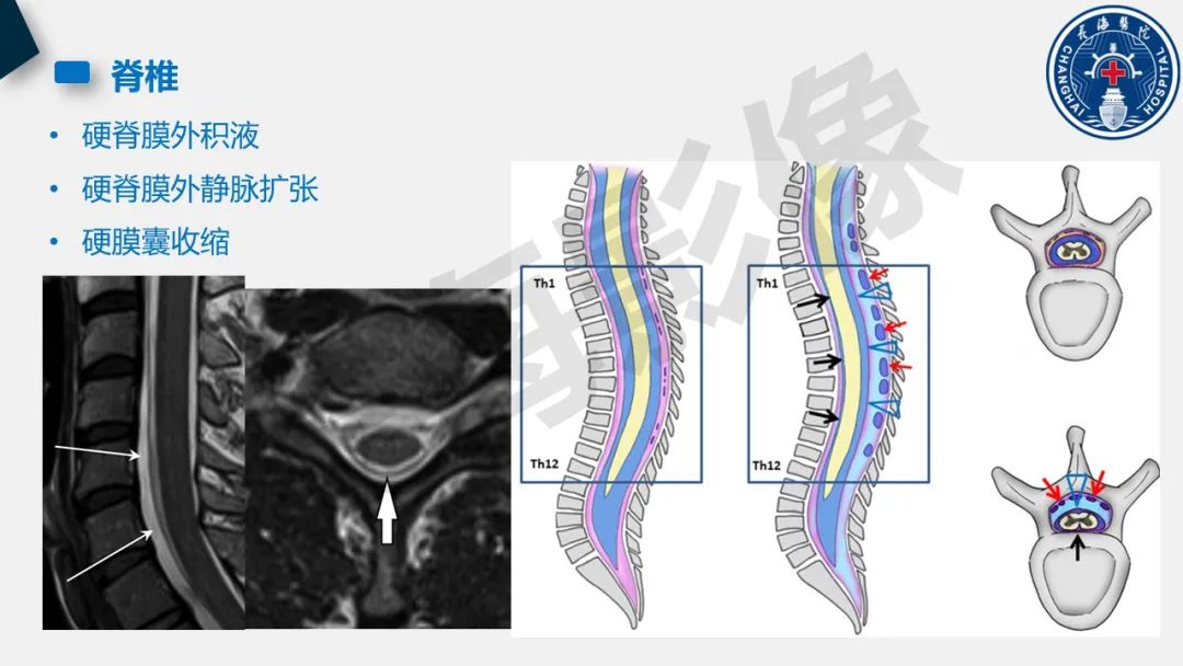 【PPT】低颅压综合征-24