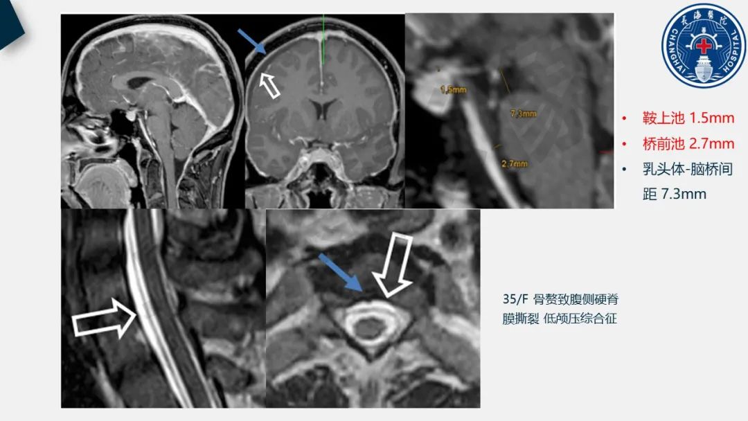 【PPT】低颅压综合征-26