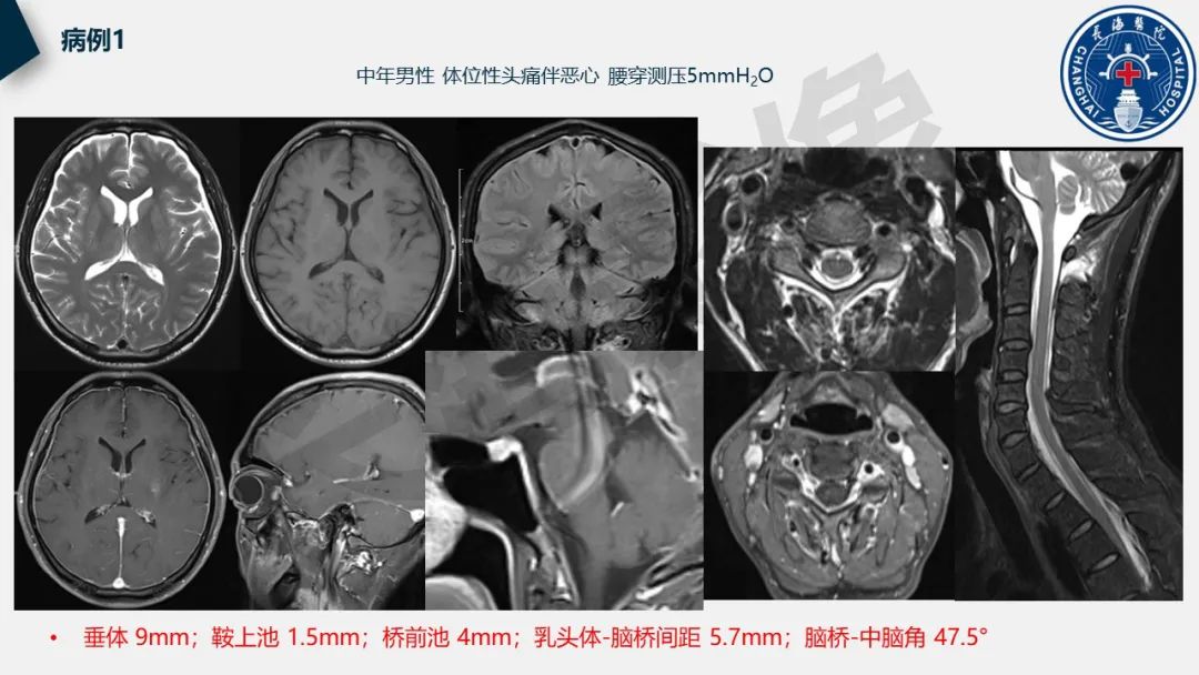 【PPT】低颅压综合征-27