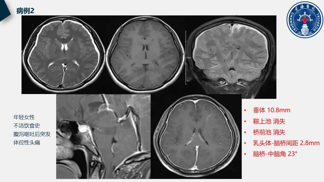 【PPT】低颅压综合征-28
