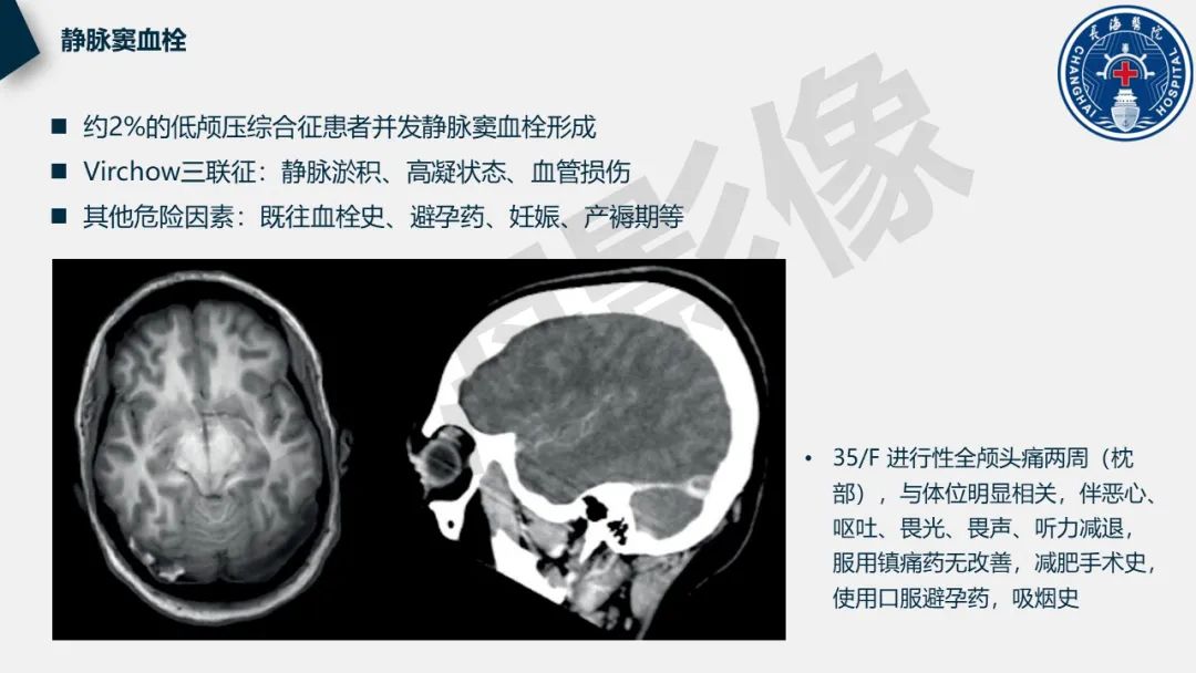 【PPT】低颅压综合征-32