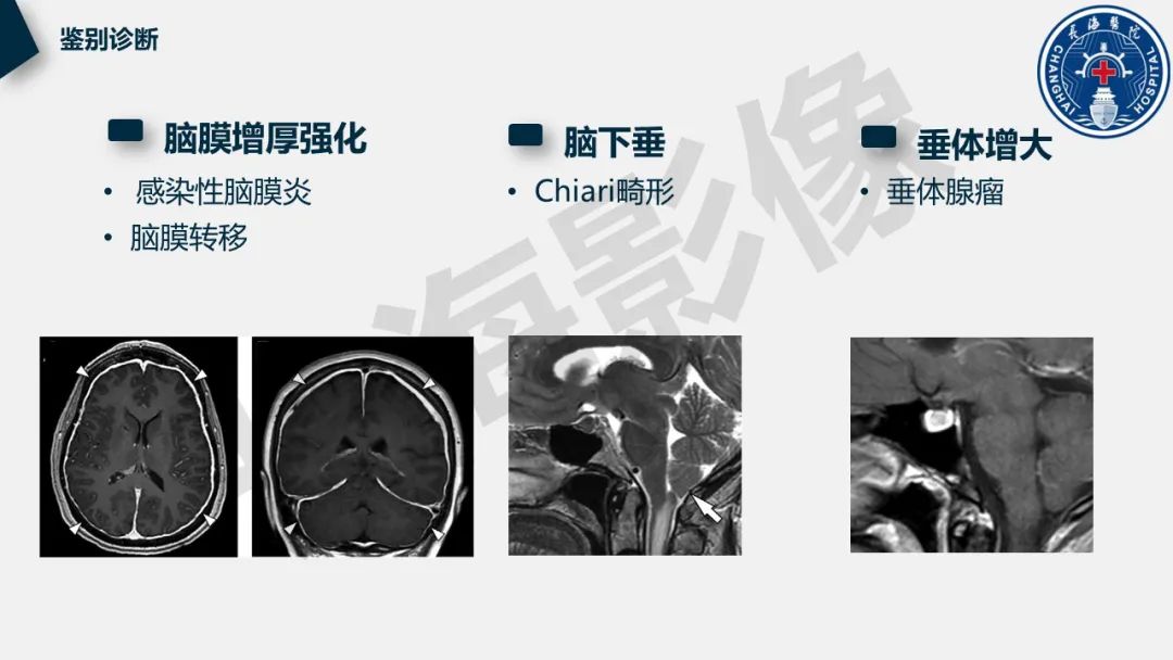 【PPT】低颅压综合征-34