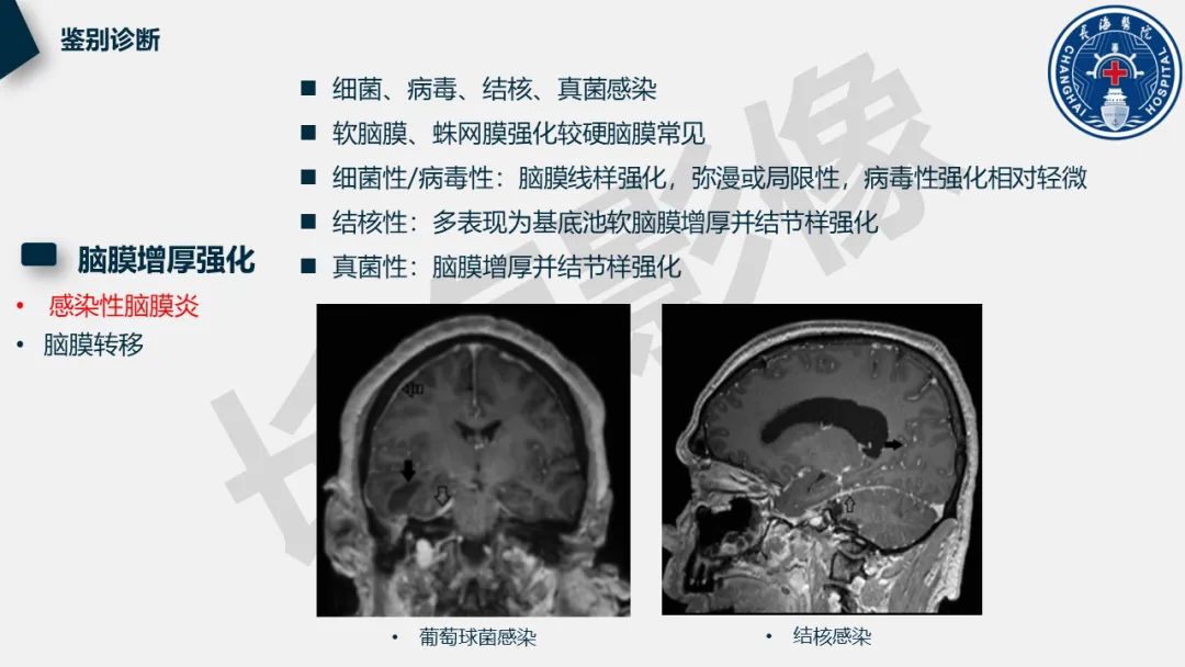 【PPT】低颅压综合征-35