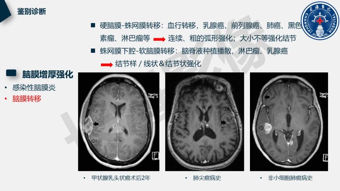 【PPT】低颅压综合征-36