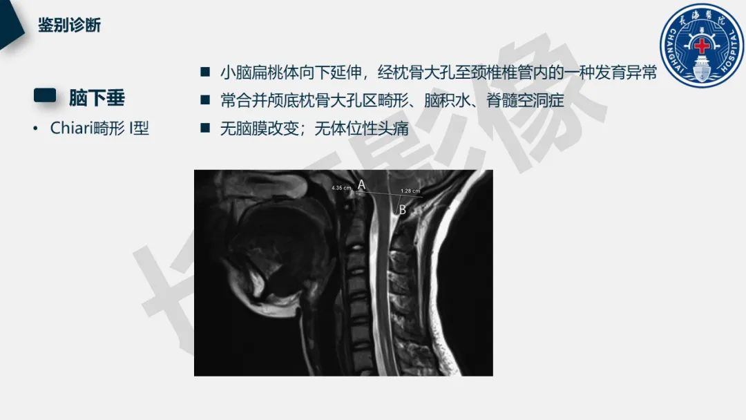 【PPT】低颅压综合征-37