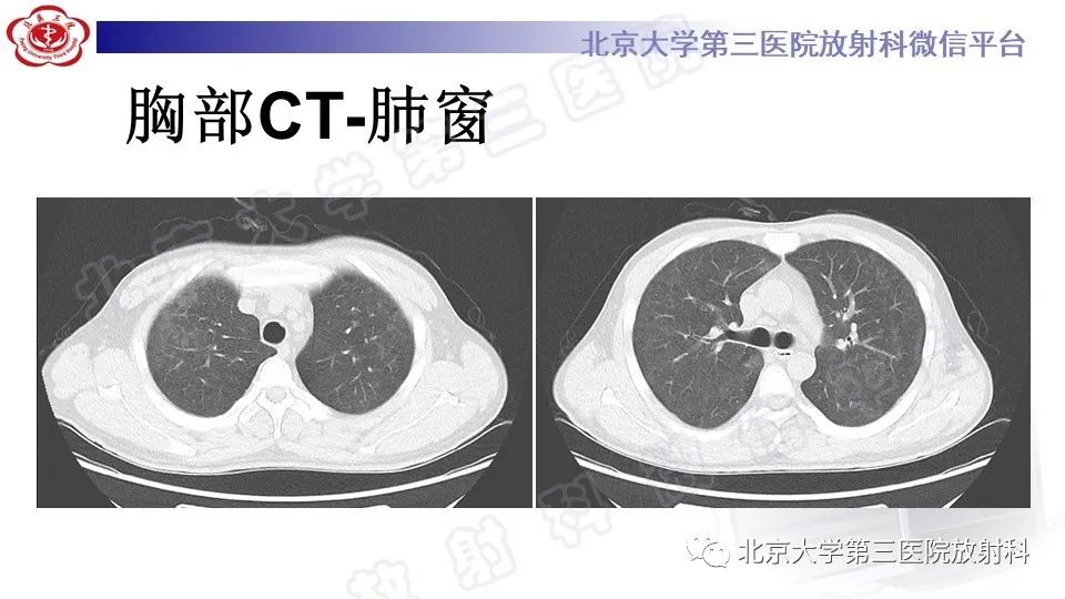 【PPT】病毒性肺炎-3