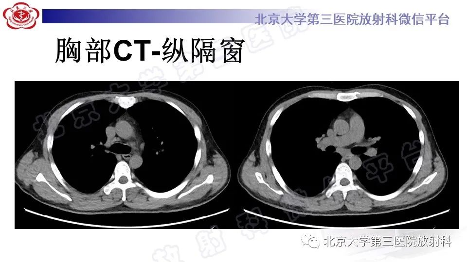 【PPT】病毒性肺炎-5