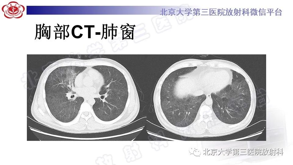【PPT】病毒性肺炎-4
