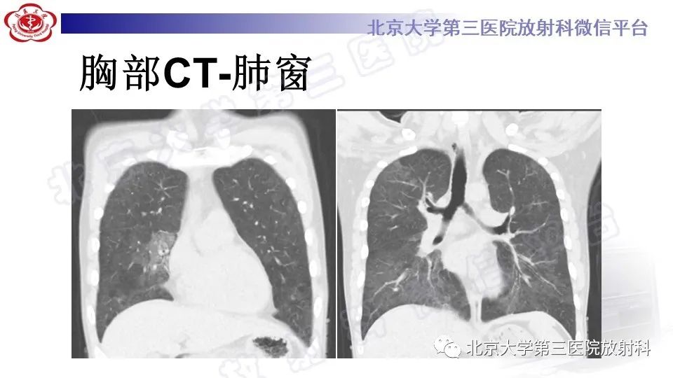 【PPT】病毒性肺炎-6