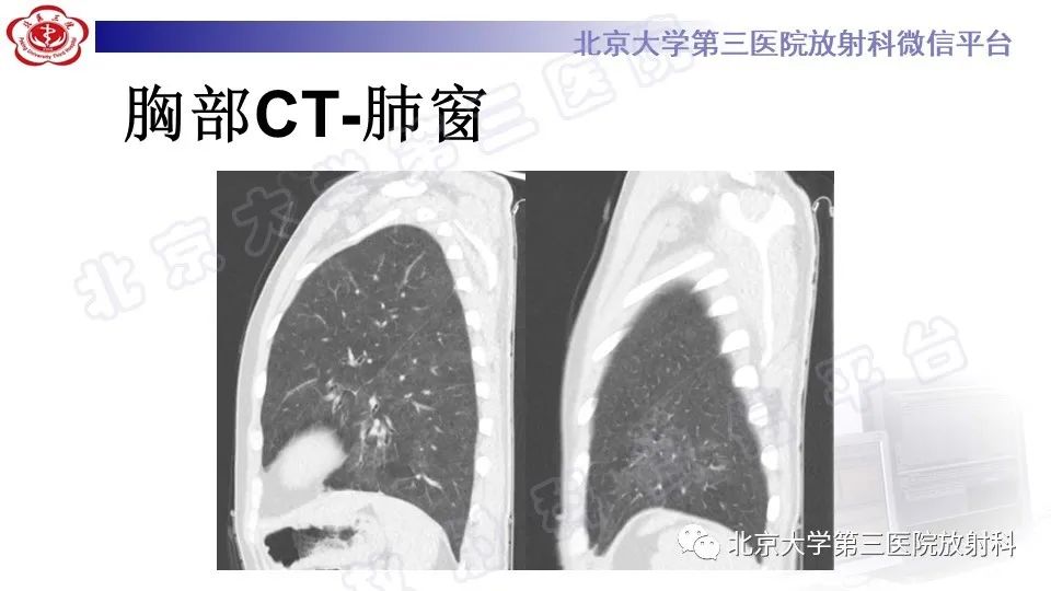 【PPT】病毒性肺炎-8