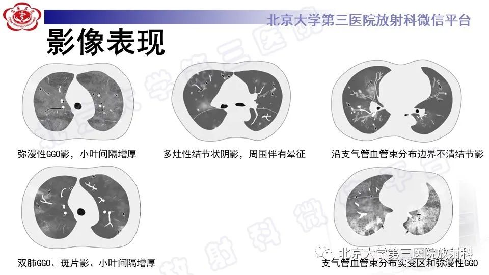 【PPT】病毒性肺炎-14