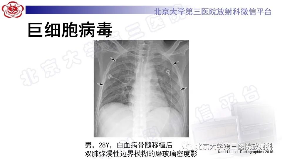 【PPT】病毒性肺炎-17