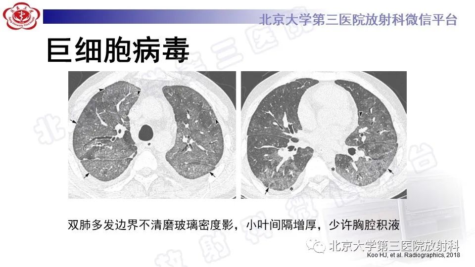 【PPT】病毒性肺炎-18