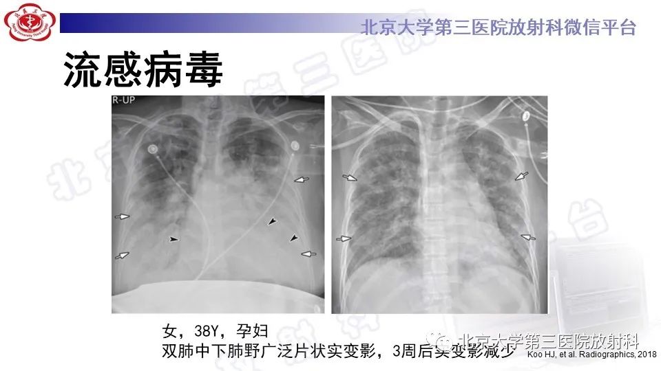 【PPT】病毒性肺炎-21