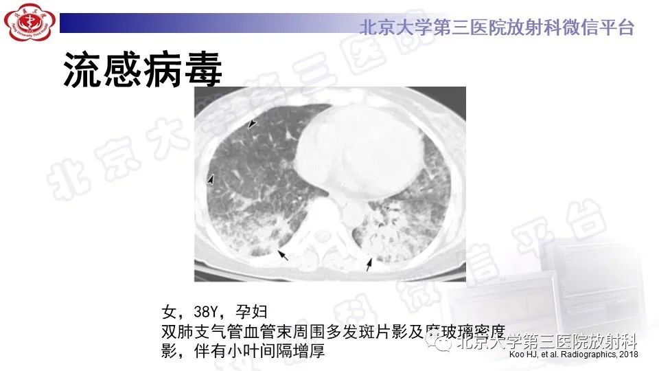 【PPT】病毒性肺炎-22