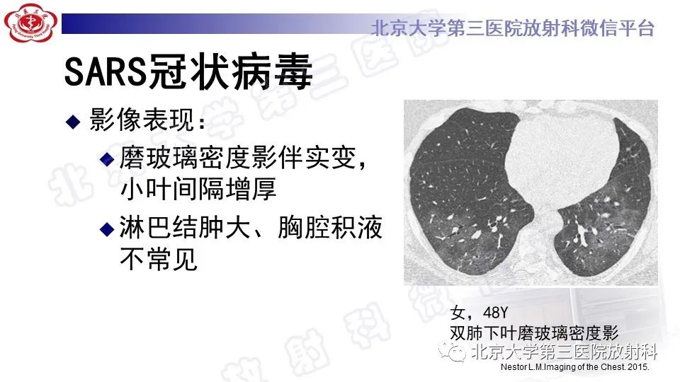 【PPT】病毒性肺炎-25