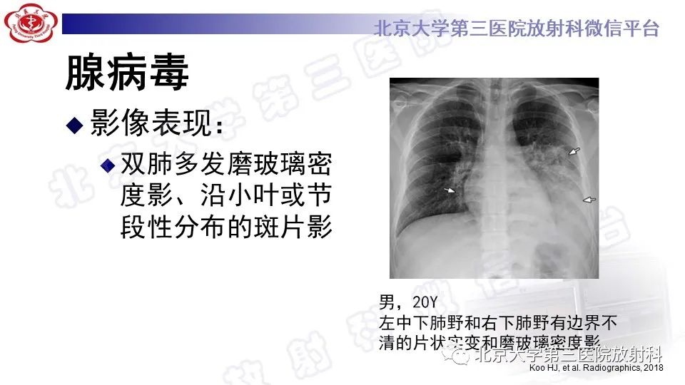 【PPT】病毒性肺炎-28