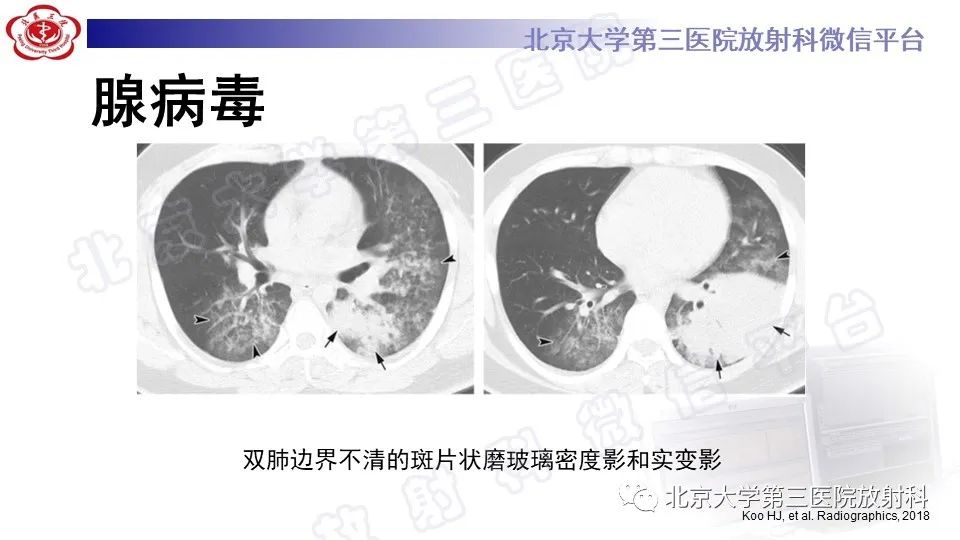 【PPT】病毒性肺炎-29