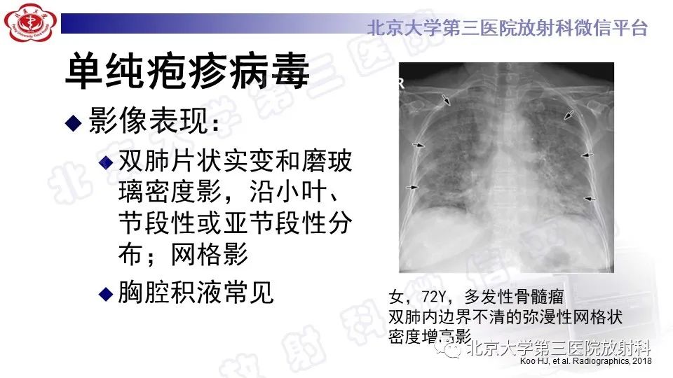 【PPT】病毒性肺炎-32