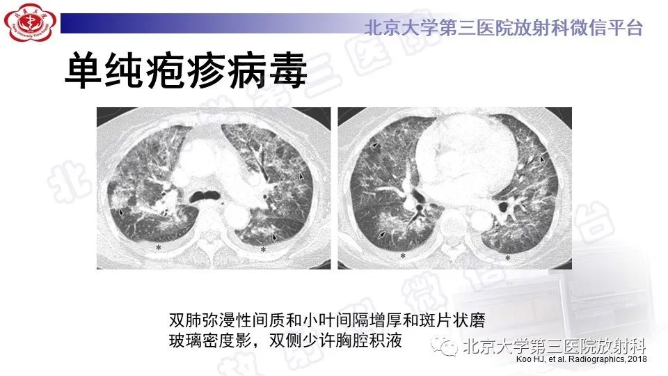 【PPT】病毒性肺炎-33