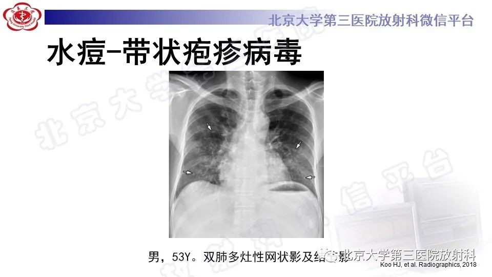 【PPT】病毒性肺炎-36
