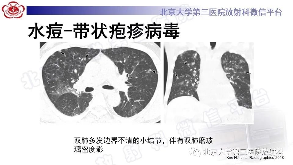 【PPT】病毒性肺炎-37