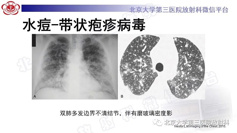 【PPT】病毒性肺炎-38