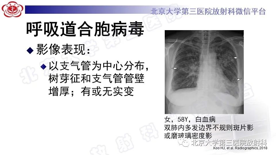 【PPT】病毒性肺炎-40