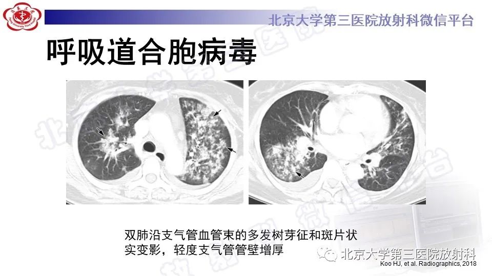 【PPT】病毒性肺炎-41
