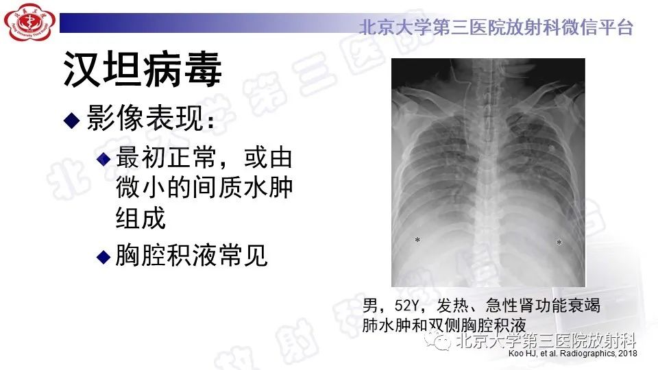 【PPT】病毒性肺炎-43