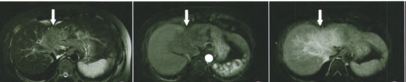 肝包膜皱缩，除了胆管细胞癌，还有这几种情况-2