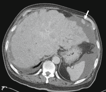 肝包膜皱缩，除了胆管细胞癌，还有这几种情况-4