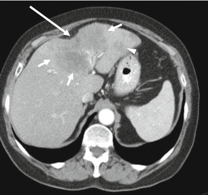 肝包膜皱缩，除了胆管细胞癌，还有这几种情况-3
