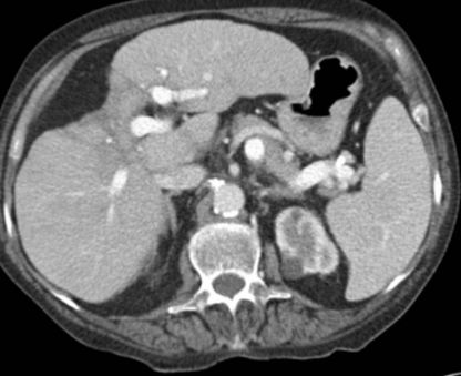 肝包膜皱缩，除了胆管细胞癌，还有这几种情况-1