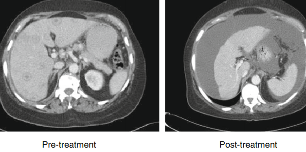 肝包膜皱缩，除了胆管细胞癌，还有这几种情况-5
