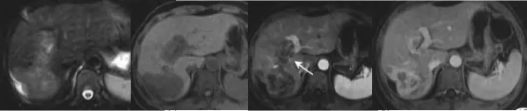 肝包膜皱缩，除了胆管细胞癌，还有这几种情况-7