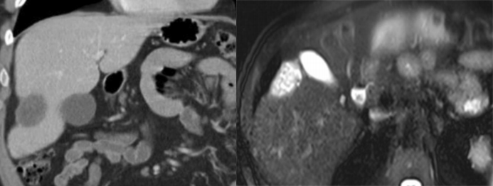 肝包膜皱缩，除了胆管细胞癌，还有这几种情况-6