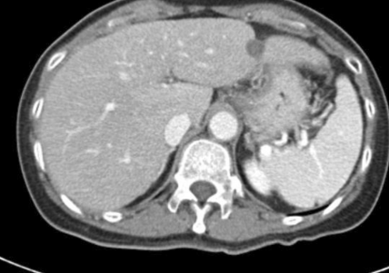 肝包膜皱缩，除了胆管细胞癌，还有这几种情况-8