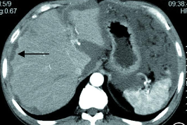 肝包膜皱缩，除了胆管细胞癌，还有这几种情况-10